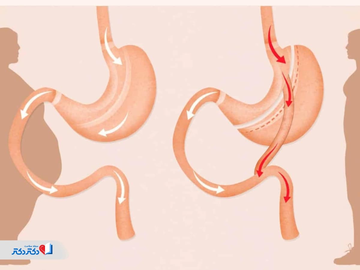 عمل بای پس معده: همه چیز درباره عمل، فواید و مراقبتها