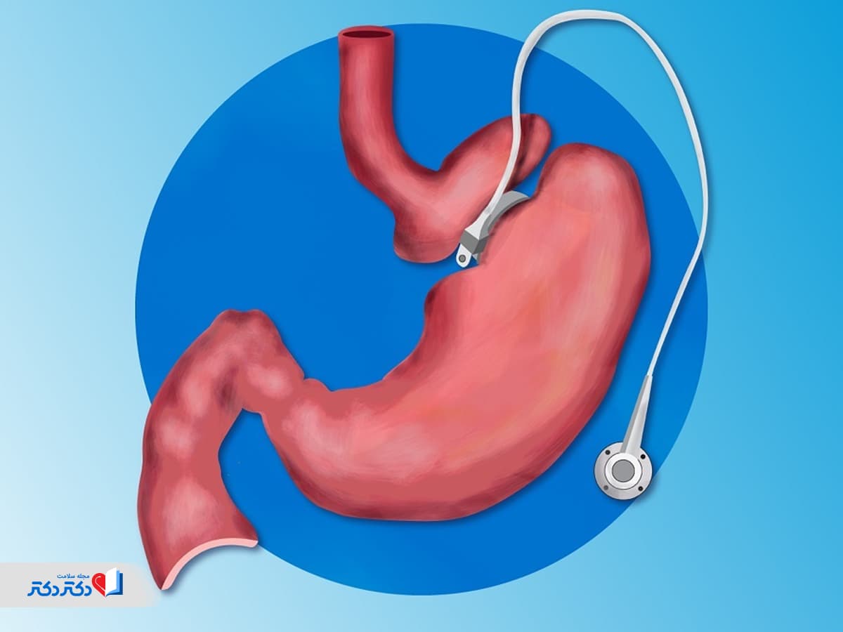 حلقه معده چیست؟ آشنایی با مزایا، عوارض و هزینههای آن