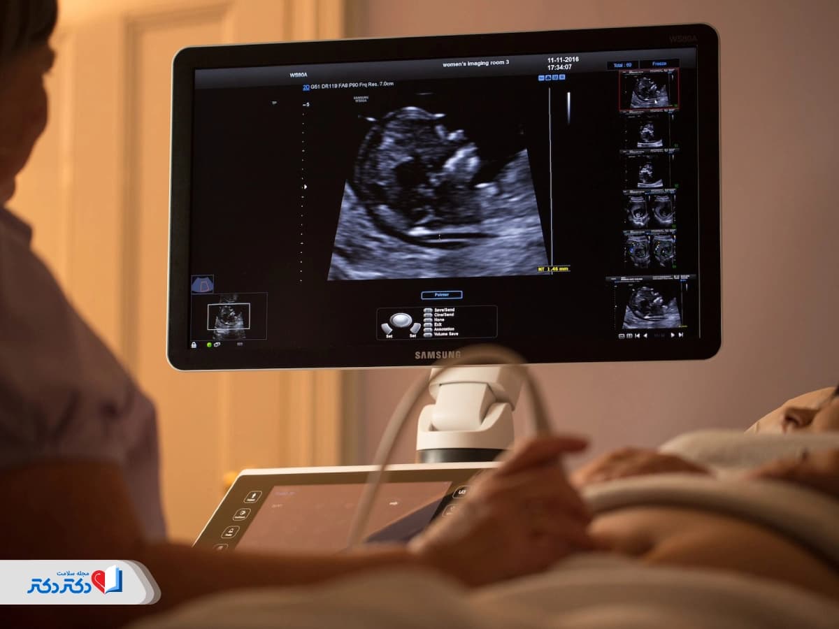 سونوگرافی NT در بارداری چیست و چه اطلاعاتی میدهد؟