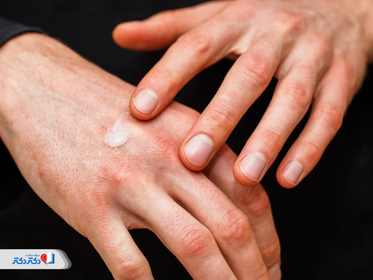 پماد فلوئوسینولون چیست و برای چه مواردی استفاده میشود؟